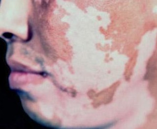 白癜风白斑扩散应怎样抑止