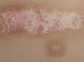 白癜风饮食要注意哪些