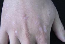 常见寻常疣的类型