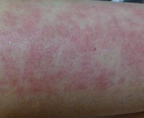 ������Ƥ�׻ᴫȾ��