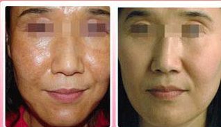 �Ŵ���ȸ�ߵ�֢״����