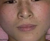 雀斑会给患者带来哪些危害呢