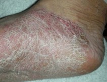 为什么会得足癣