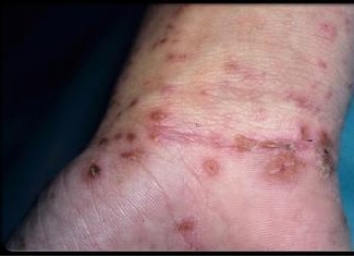 疥疮是怎样发生的