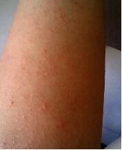 疥疮结节注重治疗