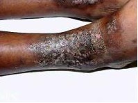 疥疮不治的后果有哪些