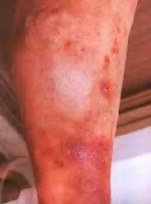 疥疮与湿疹的区别