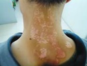 ţƤѢ�ĳ������༰��֢״