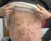 ���˽⣬ţƤѢ��ҽ���Ƹ����ô�Ҫ����