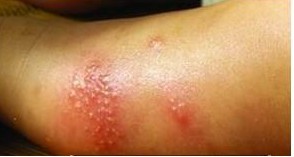 �����괯�����Ů֢״