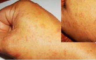 疥疮初期症状的介绍