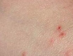 疥疮结节如何治疗