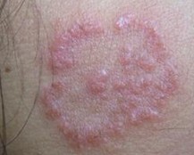 ��Ѣ������֢״����