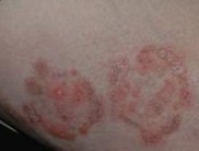 ��Ѣ��֢״����Щ