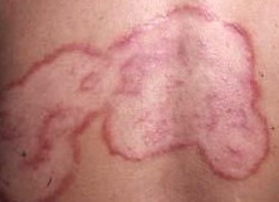 患了体癣怎么治效果更好