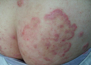 那些人易得股癣