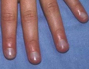 ��ָ�׻ᴫȾ��