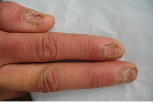 ��ָ�׳���֢״