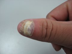 ��ָ�׻ᴫȾ��