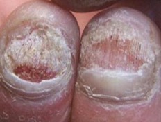 ��ֺ�׻�ָ�׵�֢״