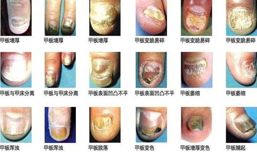 灰指甲什么症状