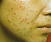 ��ƽ��֢״����Щ����