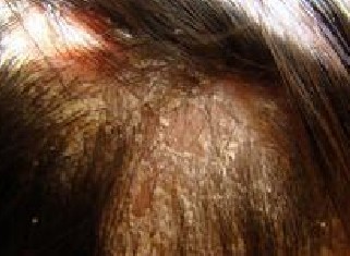 ֬�����ѷ�����֢״����Щ