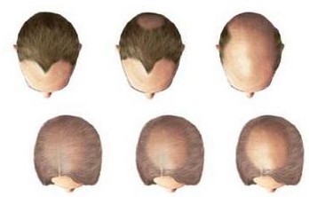 斑秃、全秃、普秃分别是怎样