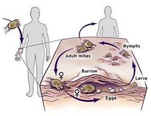 生活中需谨防疥疮感染