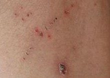 ������Ƥ������֢״