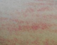 ���ּ���������Ƥ������֢״