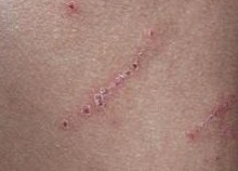 Ƥ������Ԥ����ʩ