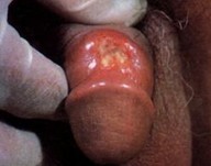 二期梅毒发病原因是什么