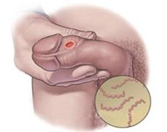 ÷��Ǳ������ʲô֢״