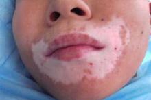 白癜风专治方法