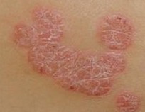 �ϲ�ţƤѢ������ѯҽ��