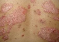 �ϲ��ĸ�ҽԺ��ţƤѢ��