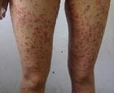 �ϲ�ţƤѢ����ҽ��