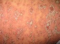 �ϲ��ĸ�ţƤѢҽԺ���