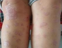 �ϲ�����õ�ţƤѢҽԺ