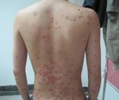 �ϲ�ţƤѢ�ļ�ҽԺ����