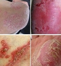 ��ͬ���͵�ţƤѢ�ֱ�����Щ֢״����