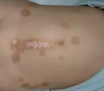 �ϲ�����ţƤѢ��ר��ҽԺ