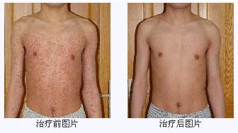 鱼鳞病康复前后对比