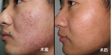 雀斑治疗前后