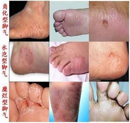 南昌中山医院手足癣症状
