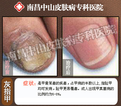 南昌中山皮肤病医院灰指甲康复前后对比