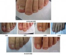 灰指甲症状