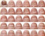 灰指甲变化过程