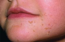 ��ƽ��֢״ͼ